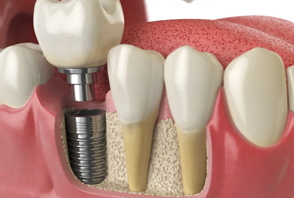 Wear a Confident Smile with Dental Implants