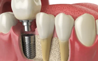 Wear a Confident Smile with Dental Implants
