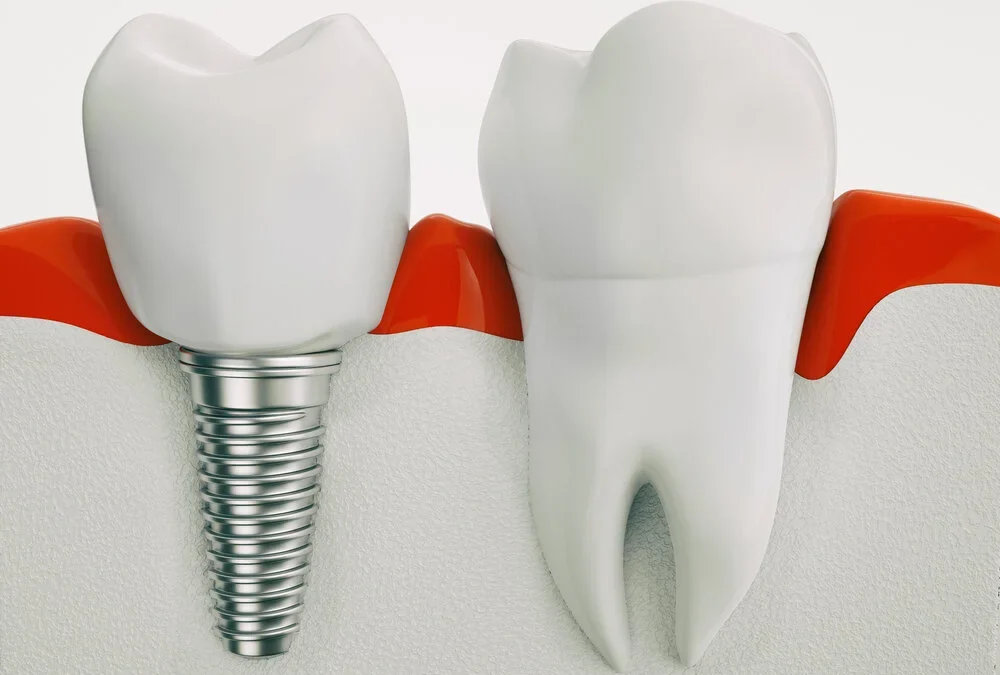 This is How Permanent Denture Procedure Will Look Like