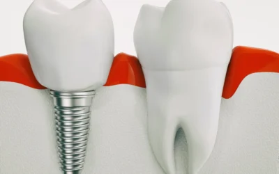This is How Permanent Denture Procedure Will Look Like