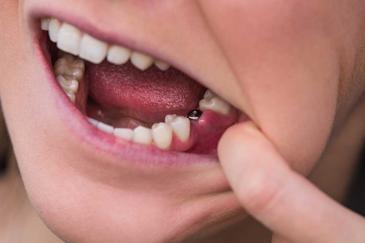 Single tooth dental implant
