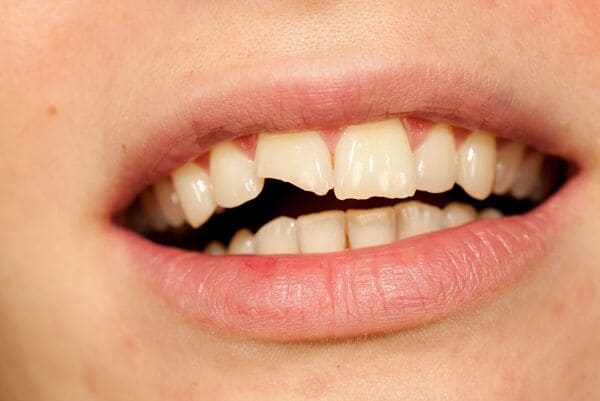 Dental evaluation for a chipped or fractured tooth
