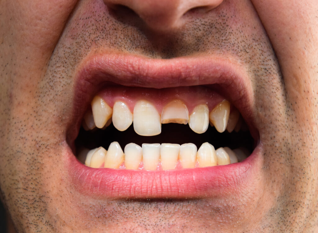 Cracked or injured tooth