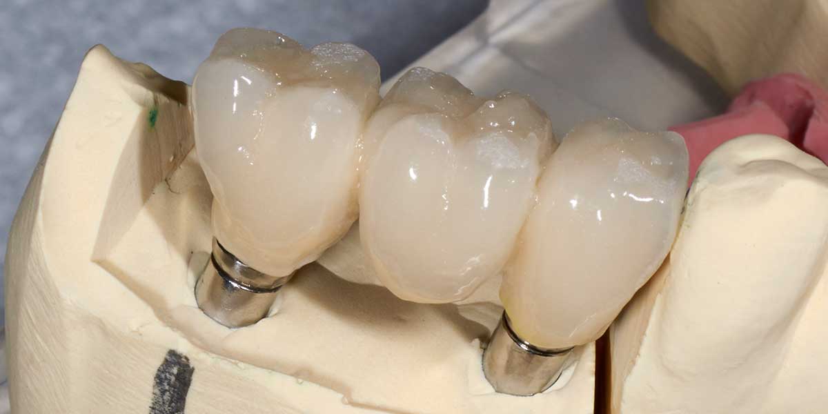 Implant-supported dental bridge