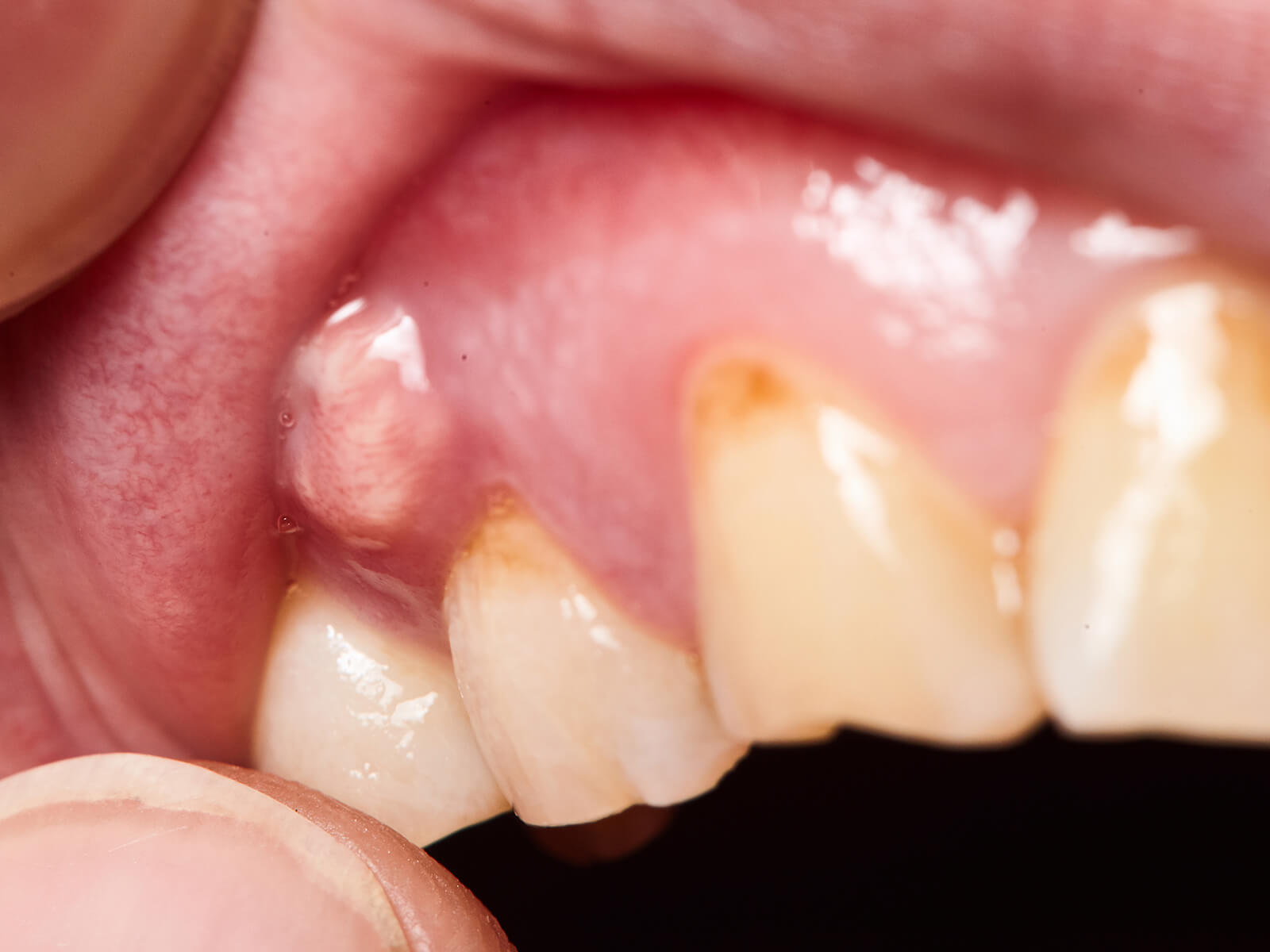 Dental abscess and tooth infection
