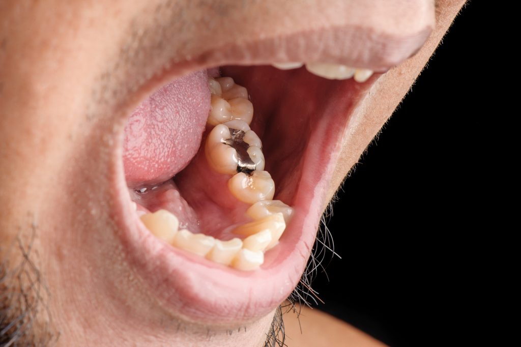 Dentist evaluating an older dental filling