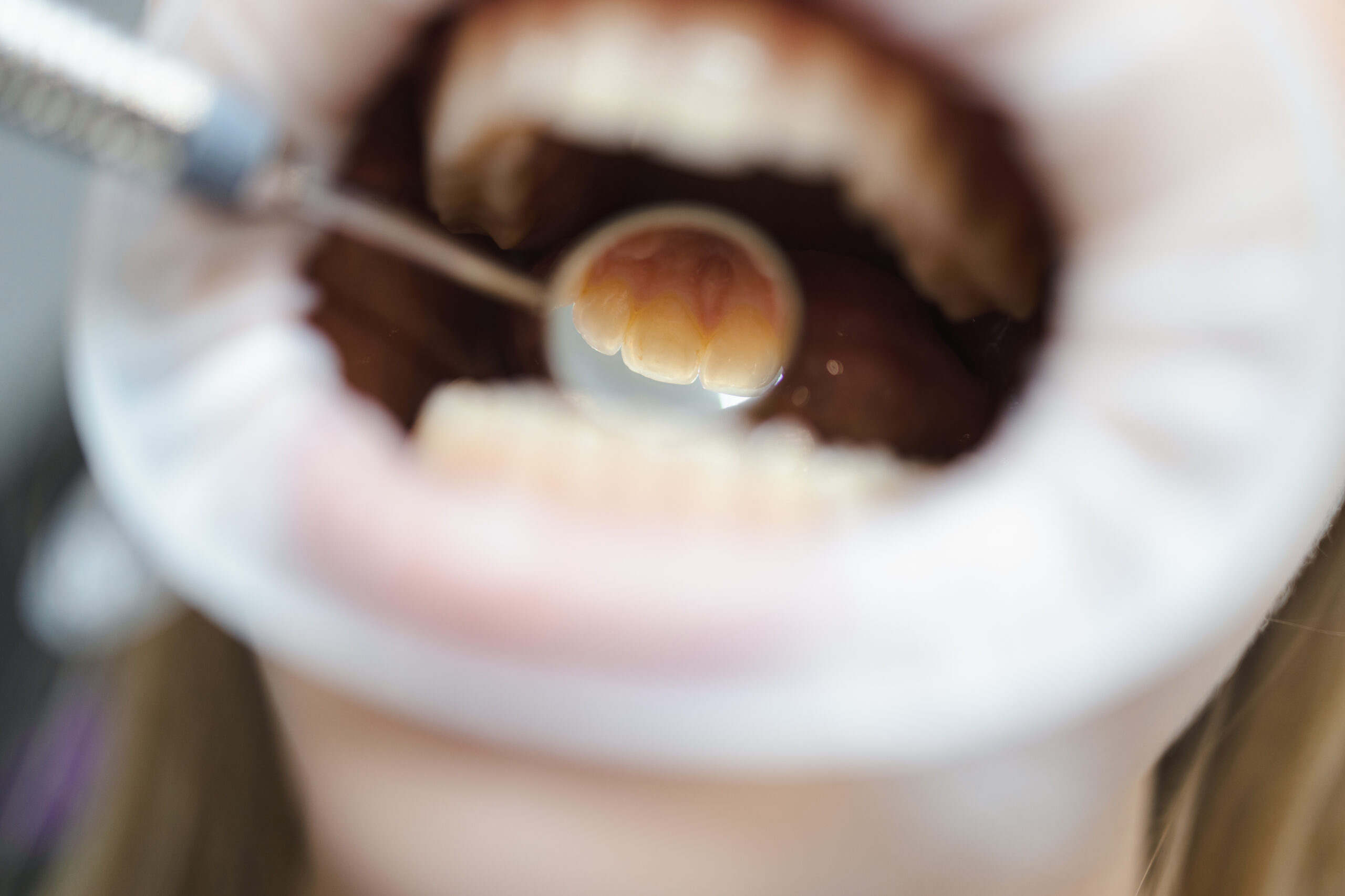 Tooth-colored composite dental filling