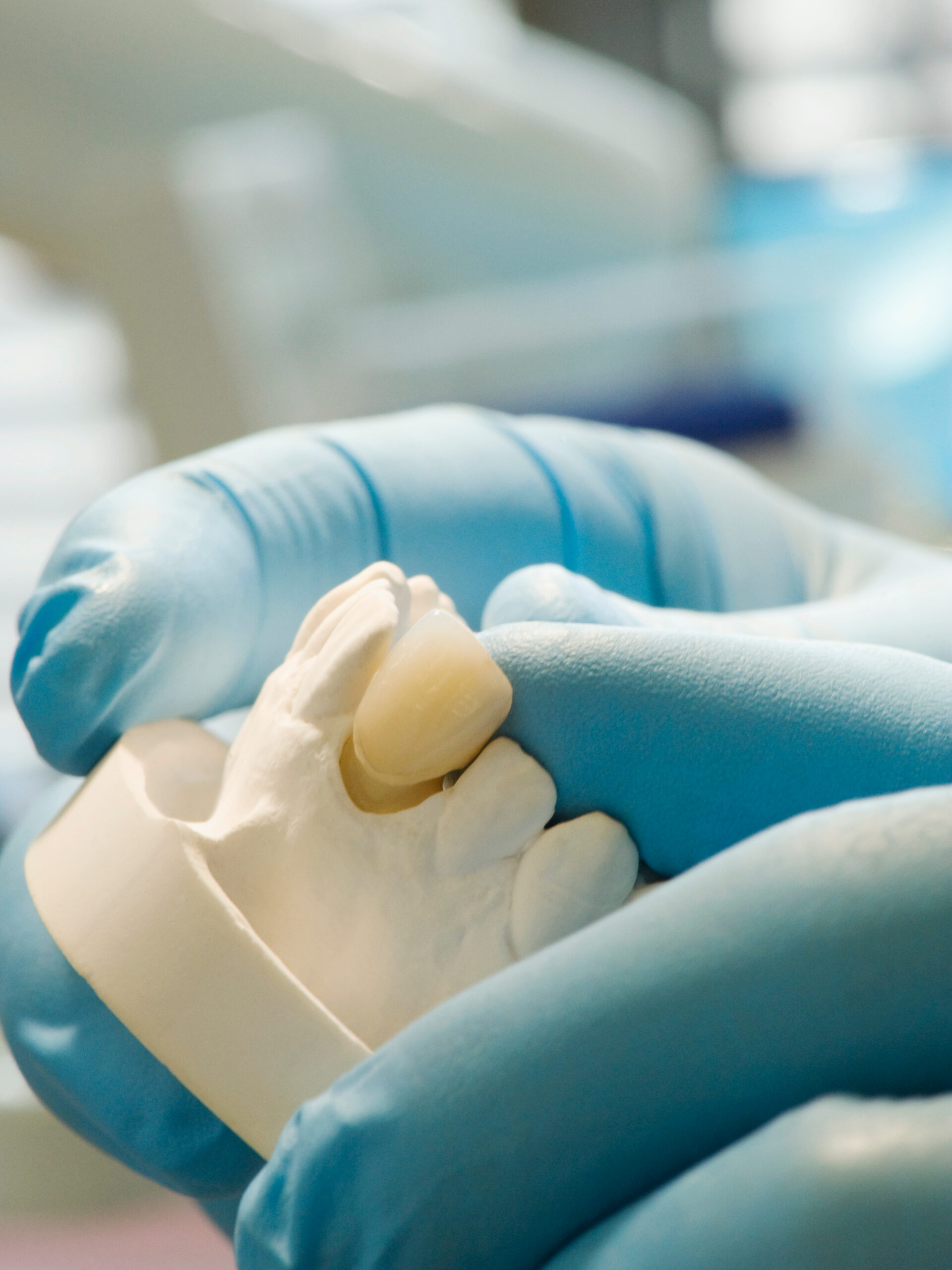 Traditional dental crown restoration