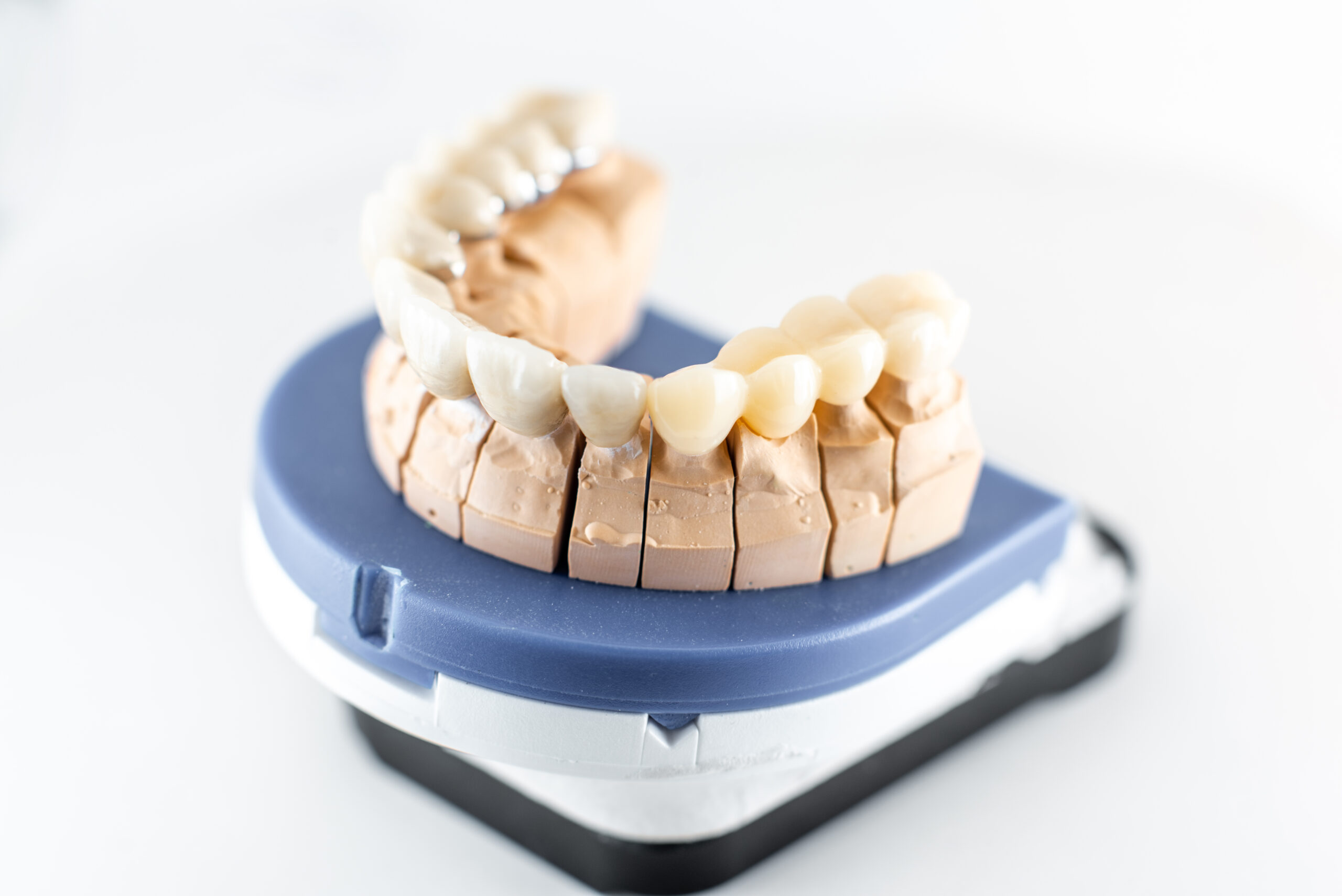 Dental model displaying a crown and bridge restoration