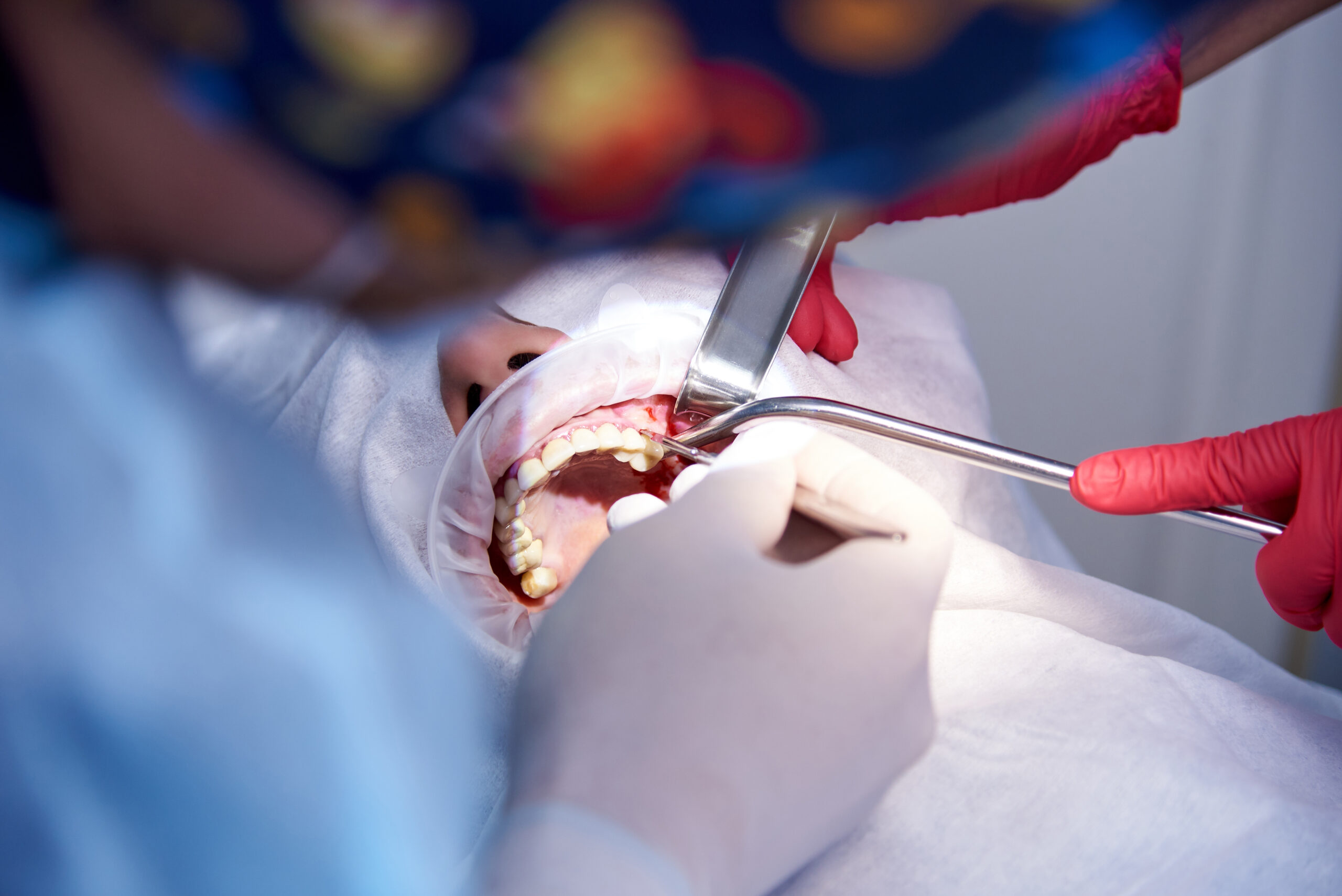 Dental extraction procedure at Comprehensive Family Dentistry