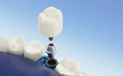 Give Your Beautiful Smile the Same Charm with Dental Implant