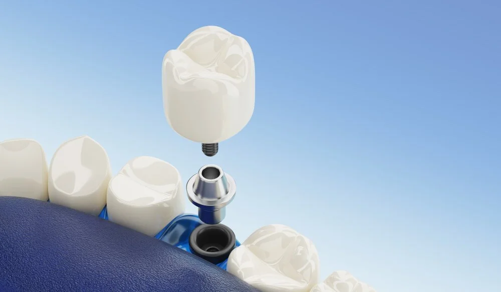 Give Your Beautiful Smile the Same Charm with Dental Implant