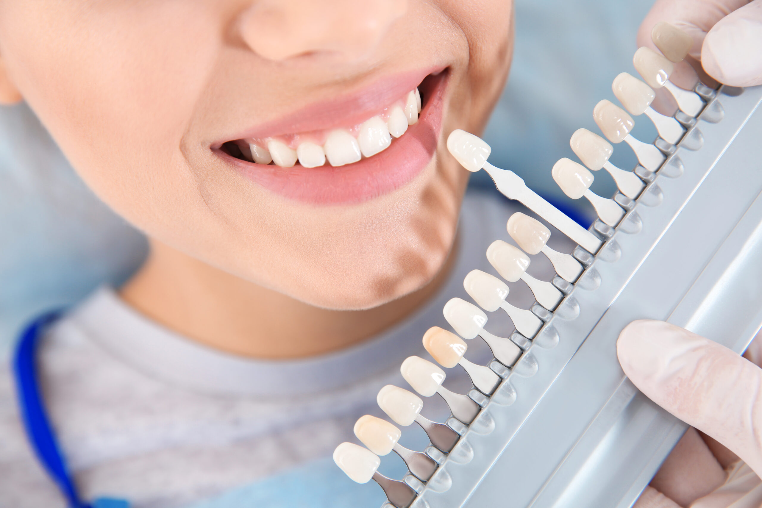 Dentist selecting a patient's tooth shade before professional teeth whitening