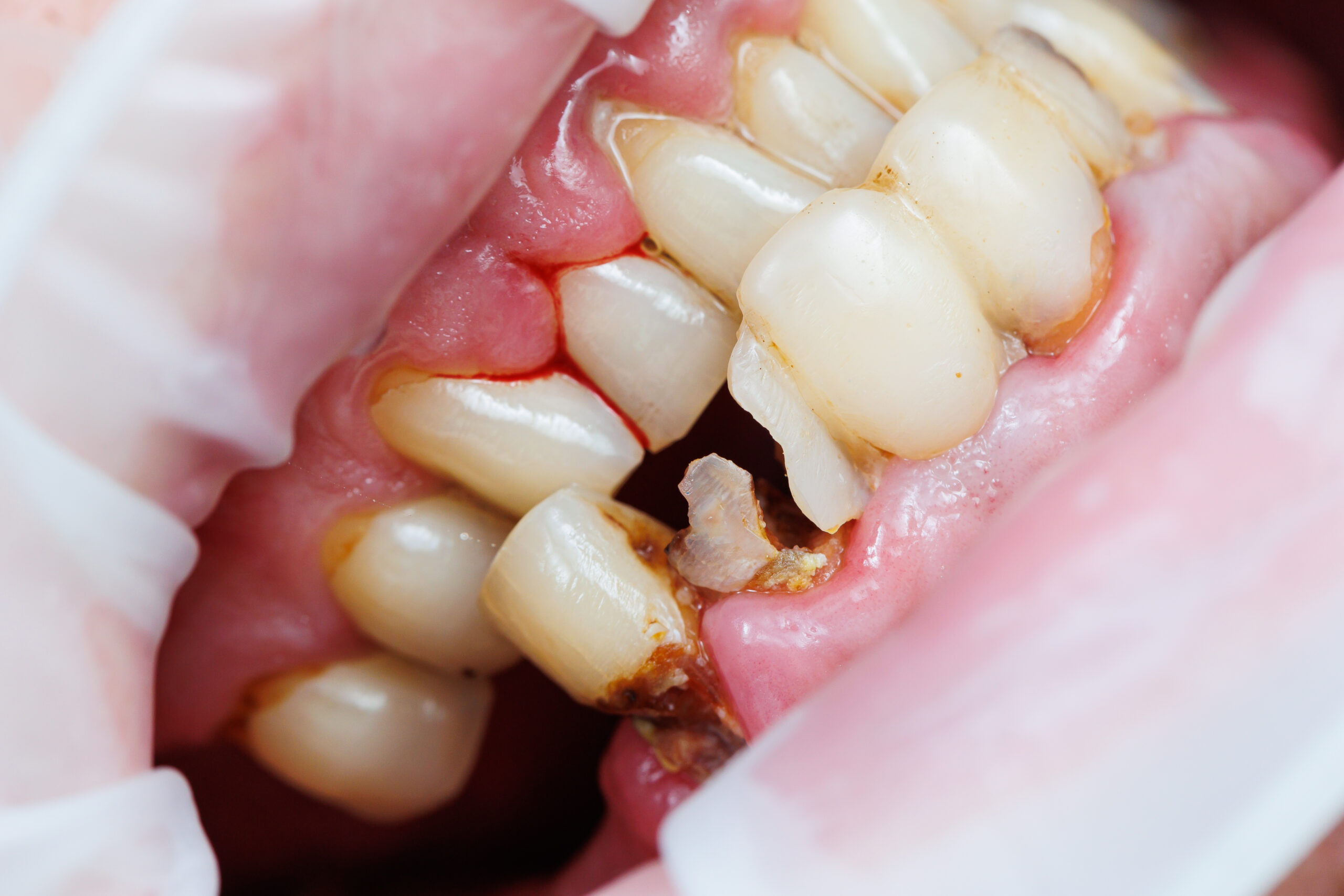 Dental examination showing deep tooth decay