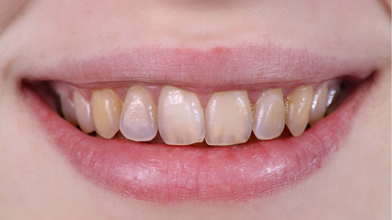 Dentist examining worn tooth surfaces
