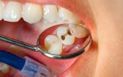 Never Ignore the Symptoms of Cavity