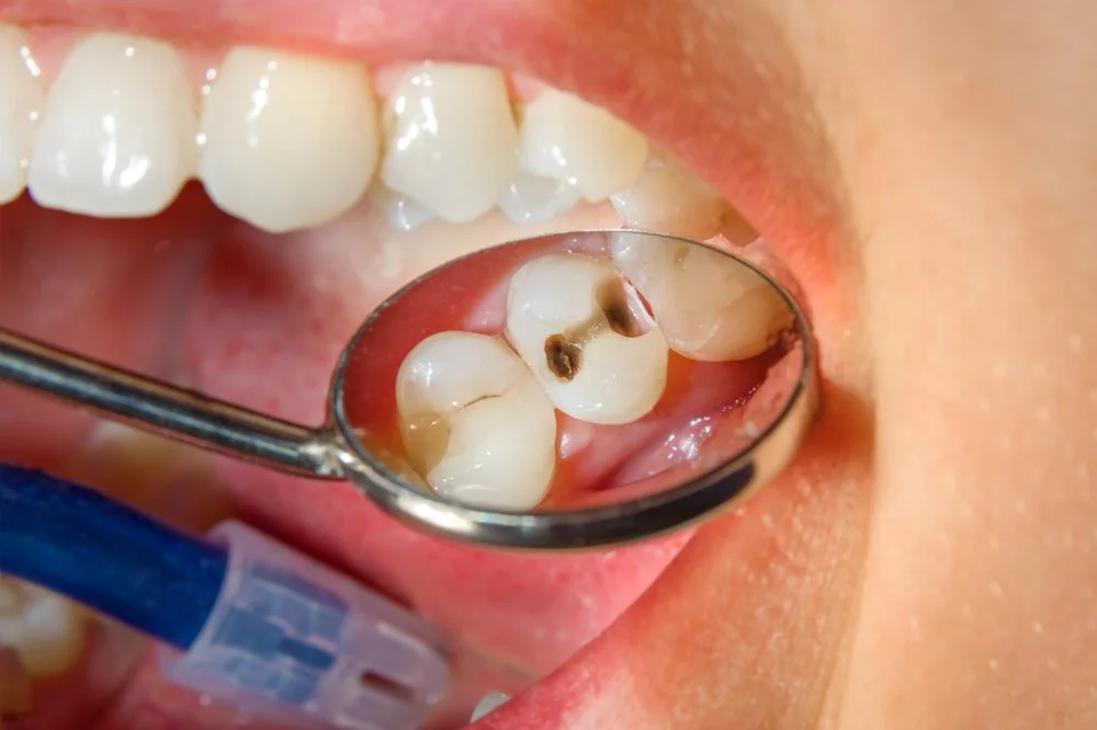 Cavity and dentist