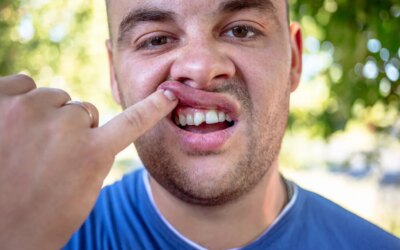 Fix Your Chipped Tooth Easily Under Cosmetic Dentistry