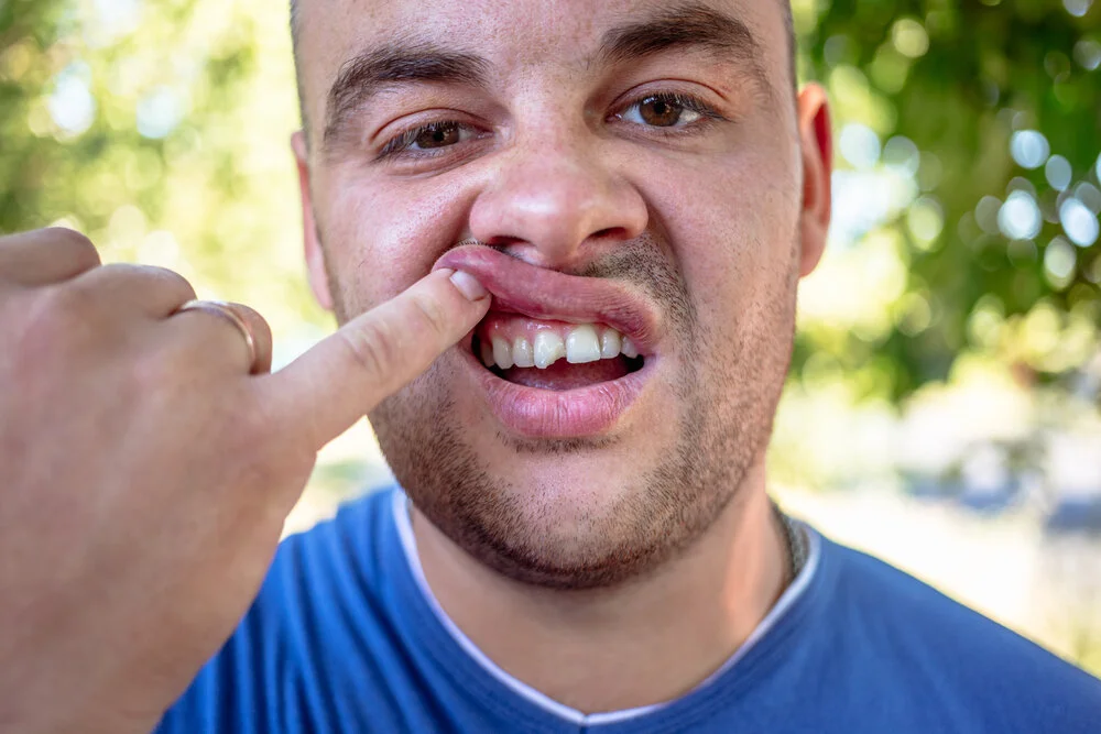 Fix Your Chipped Tooth Easily Under Cosmetic Dentistry