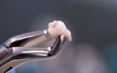 Tooth Extraction : A Comprehensive Guide