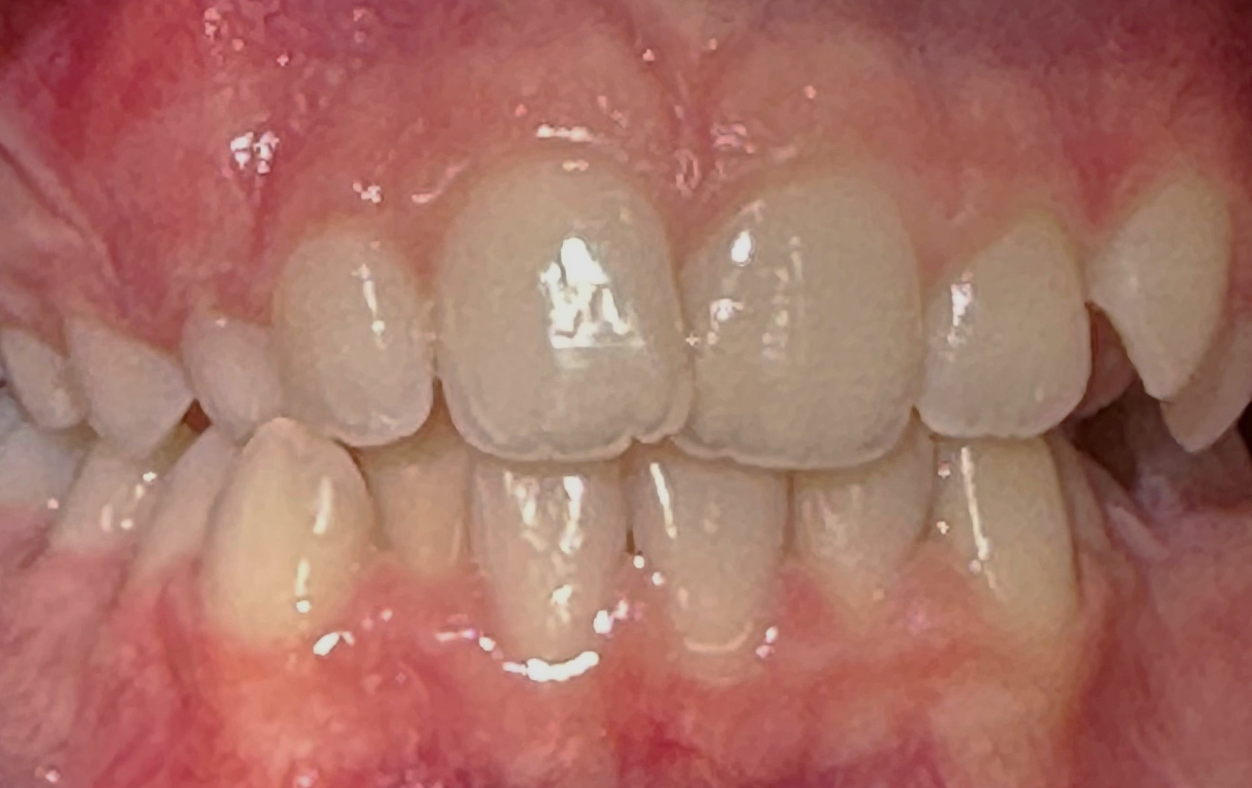 Orthodontics patient before treatment