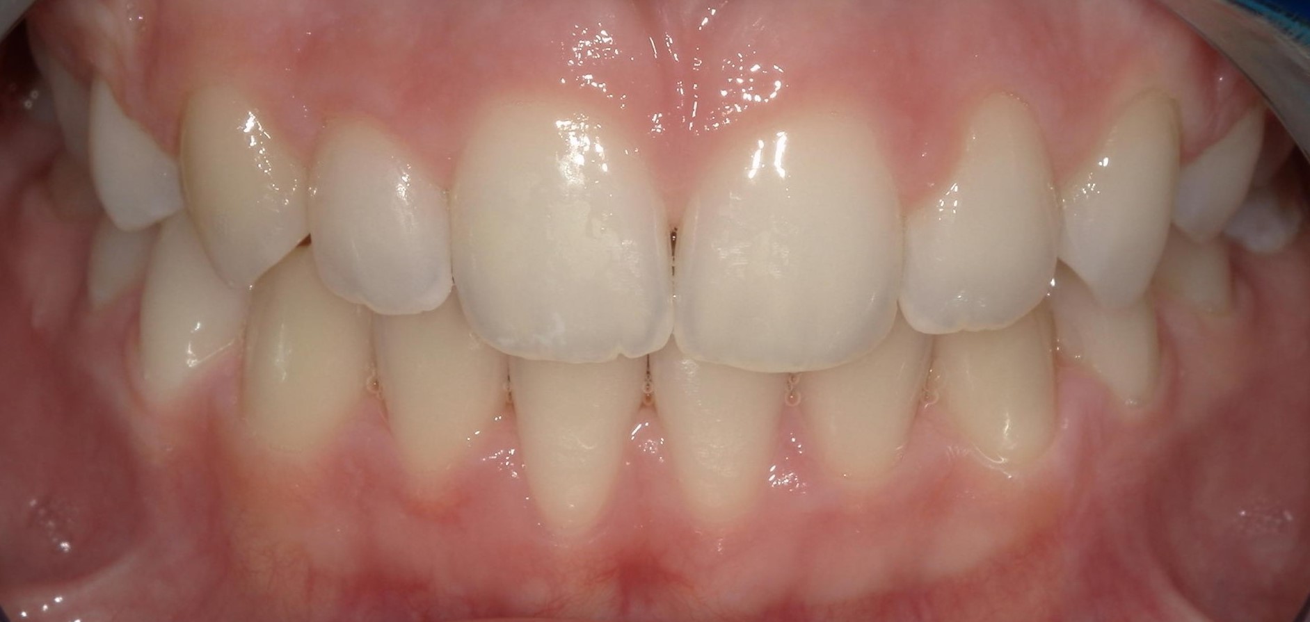 Orthodontics patient after treatment
