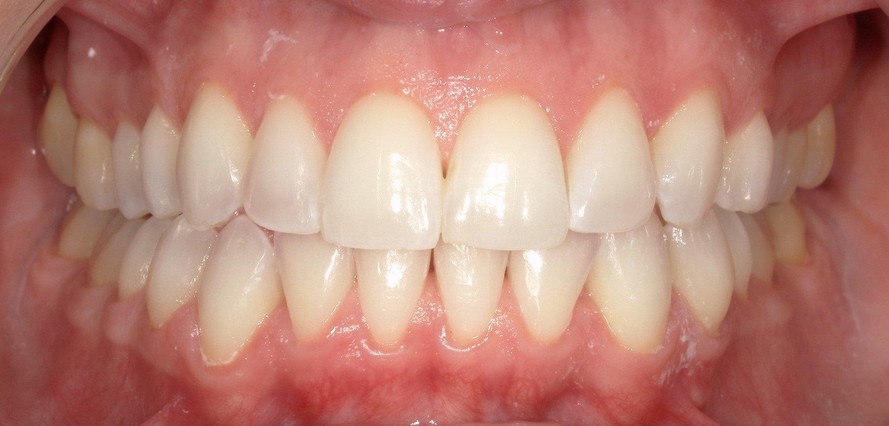Orthodontics broad smile after treatment