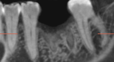 Dental implant patient during treatment