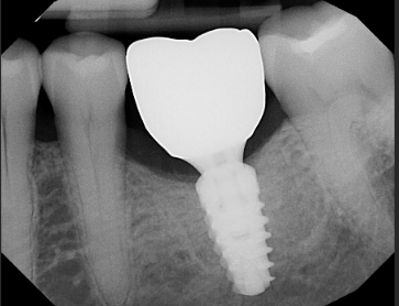 Dental implant patient after treatment