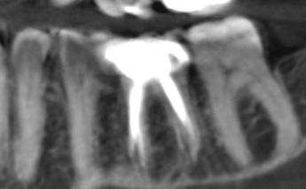 Dental implant patient before treatment