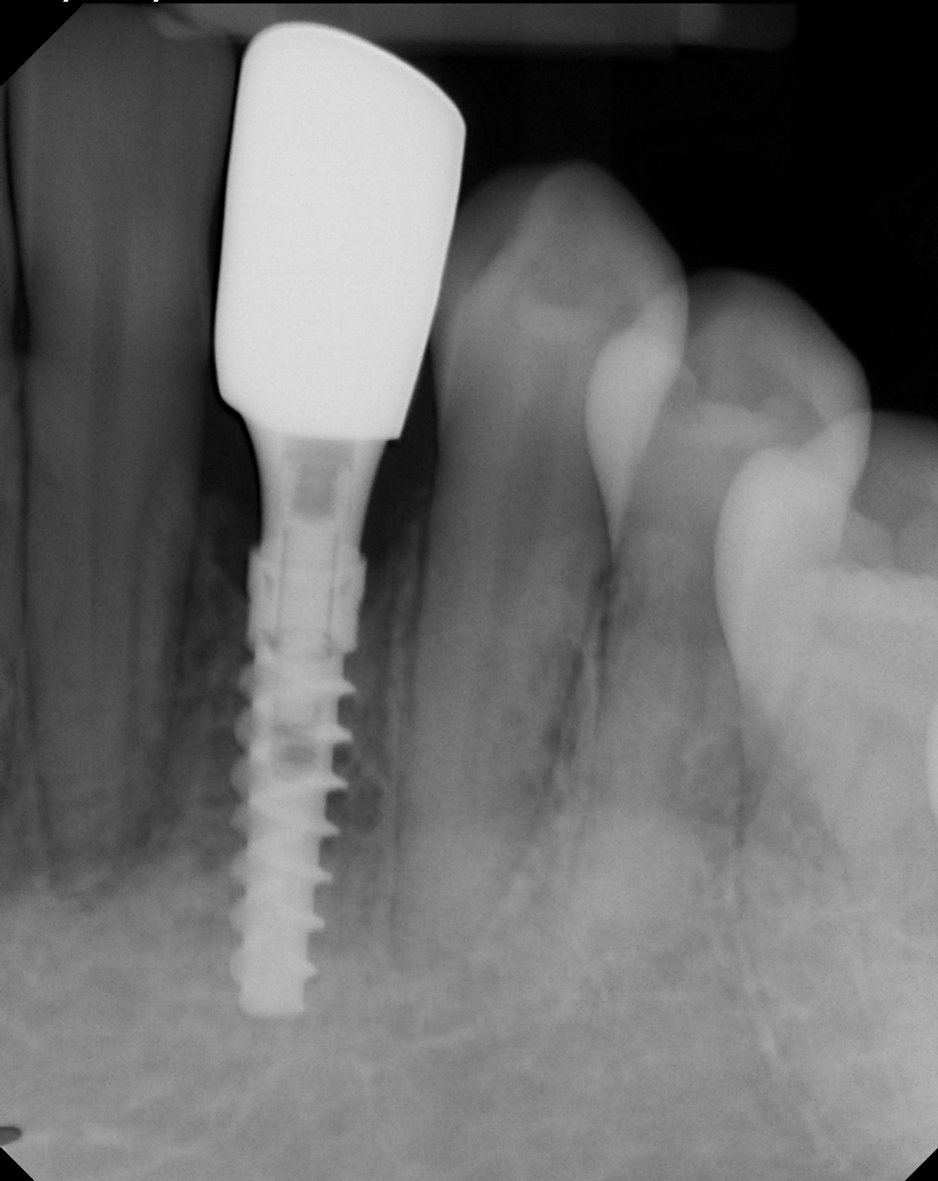Dental implant patient after treatment