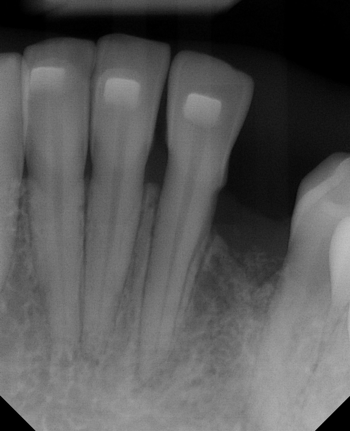 Dental implant patient before treatment