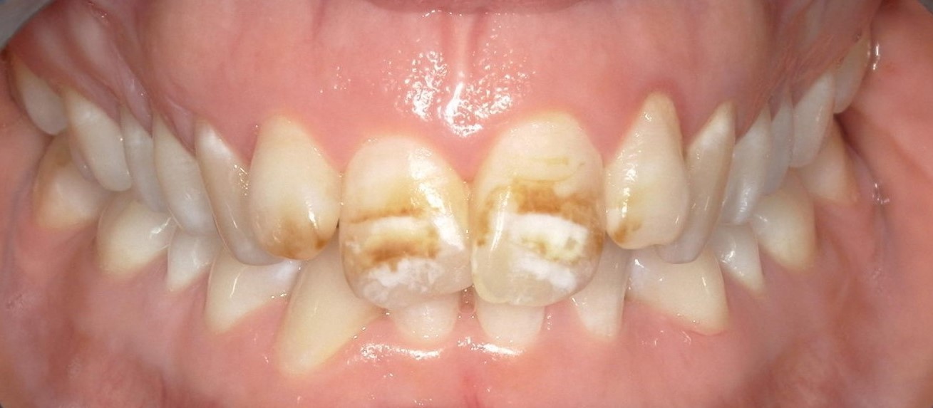 Orthodontics smile before treatment