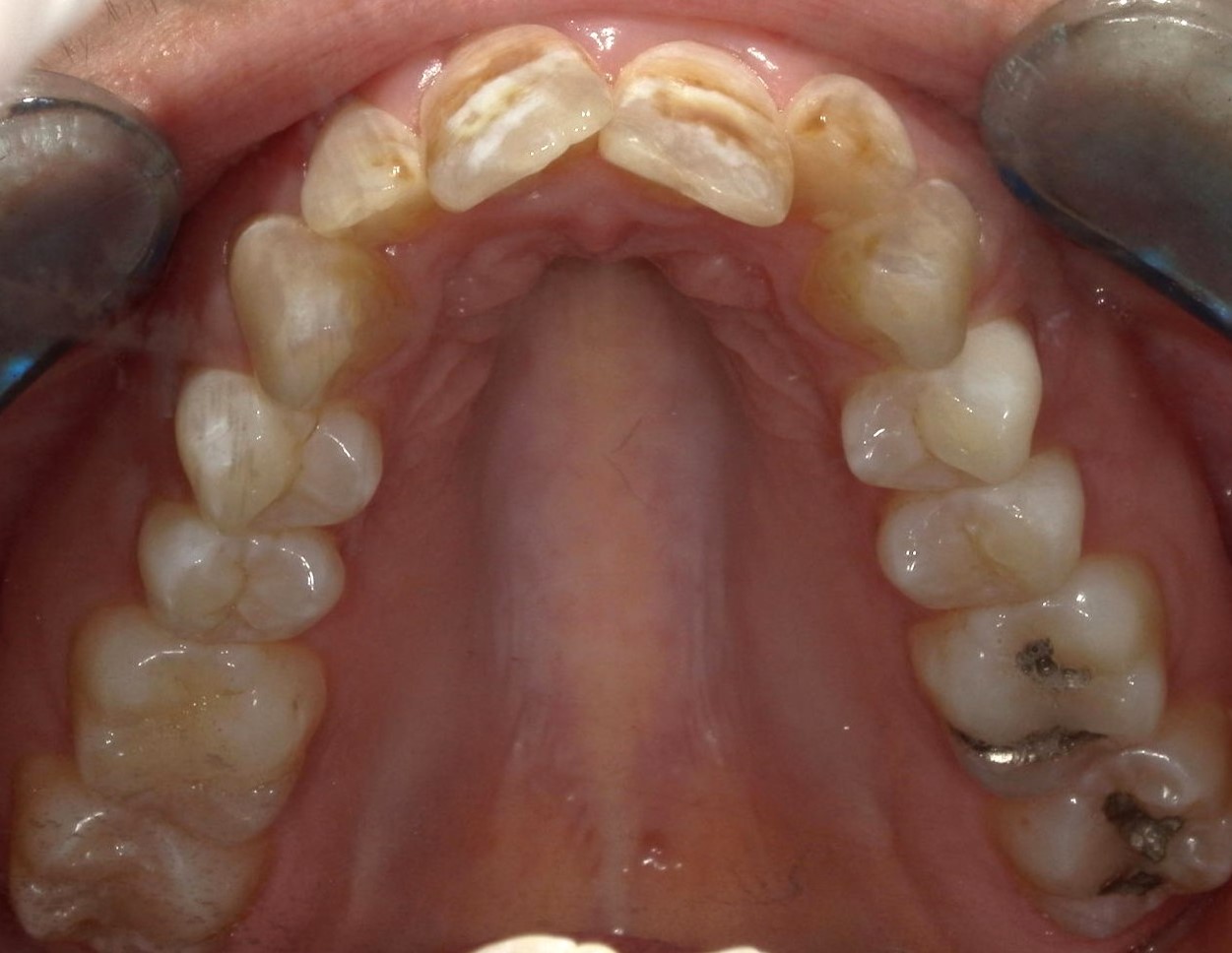 Orthodontics maxillary arch before treatment