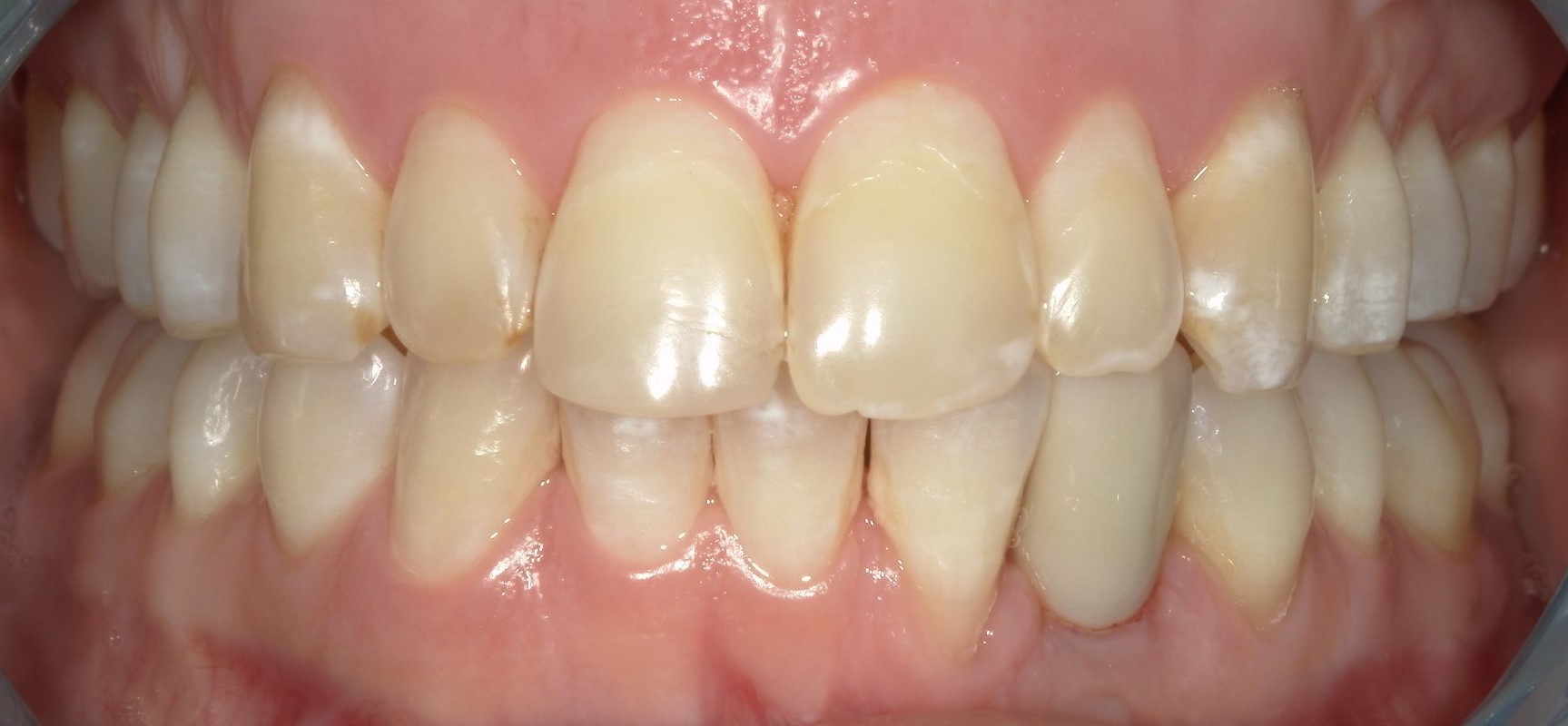 Orthodontics maxillary arch after treatment