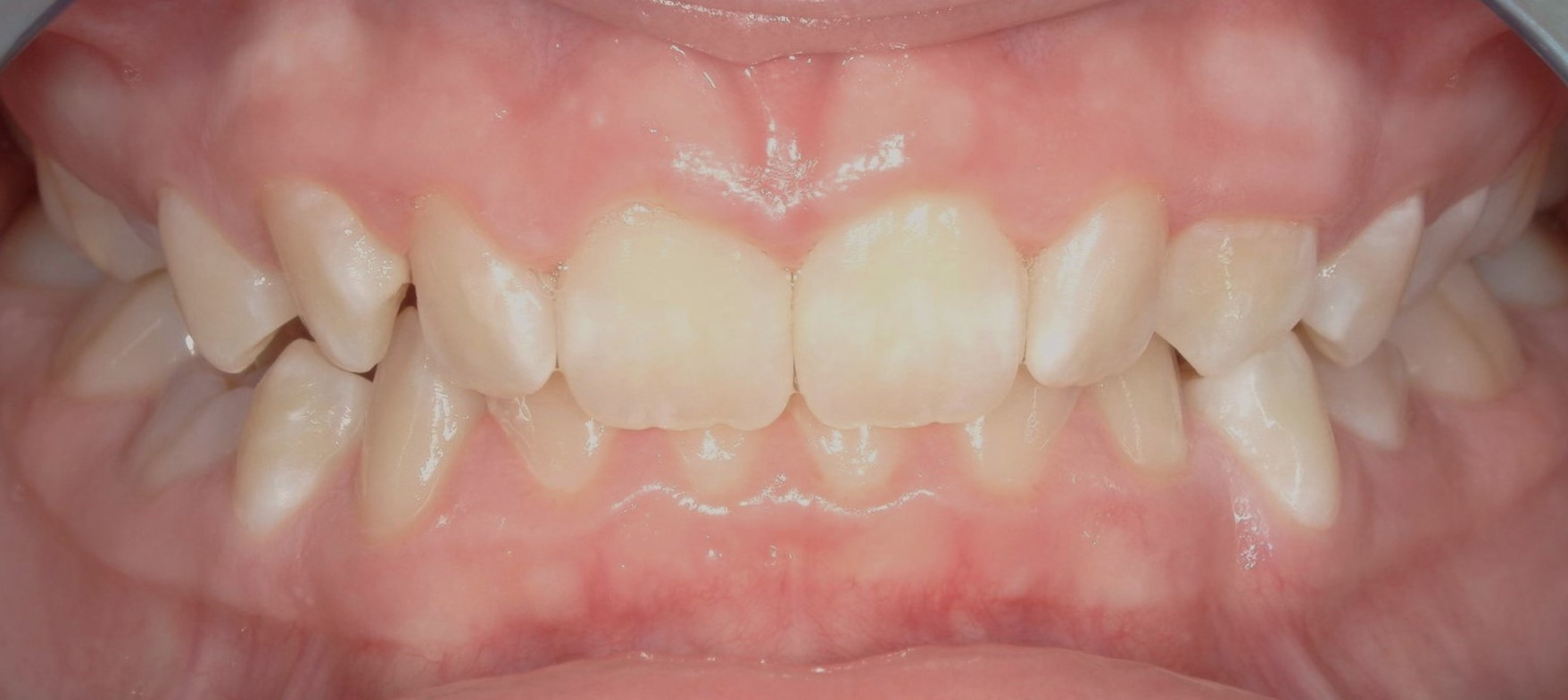Orthodontics patient before treatment