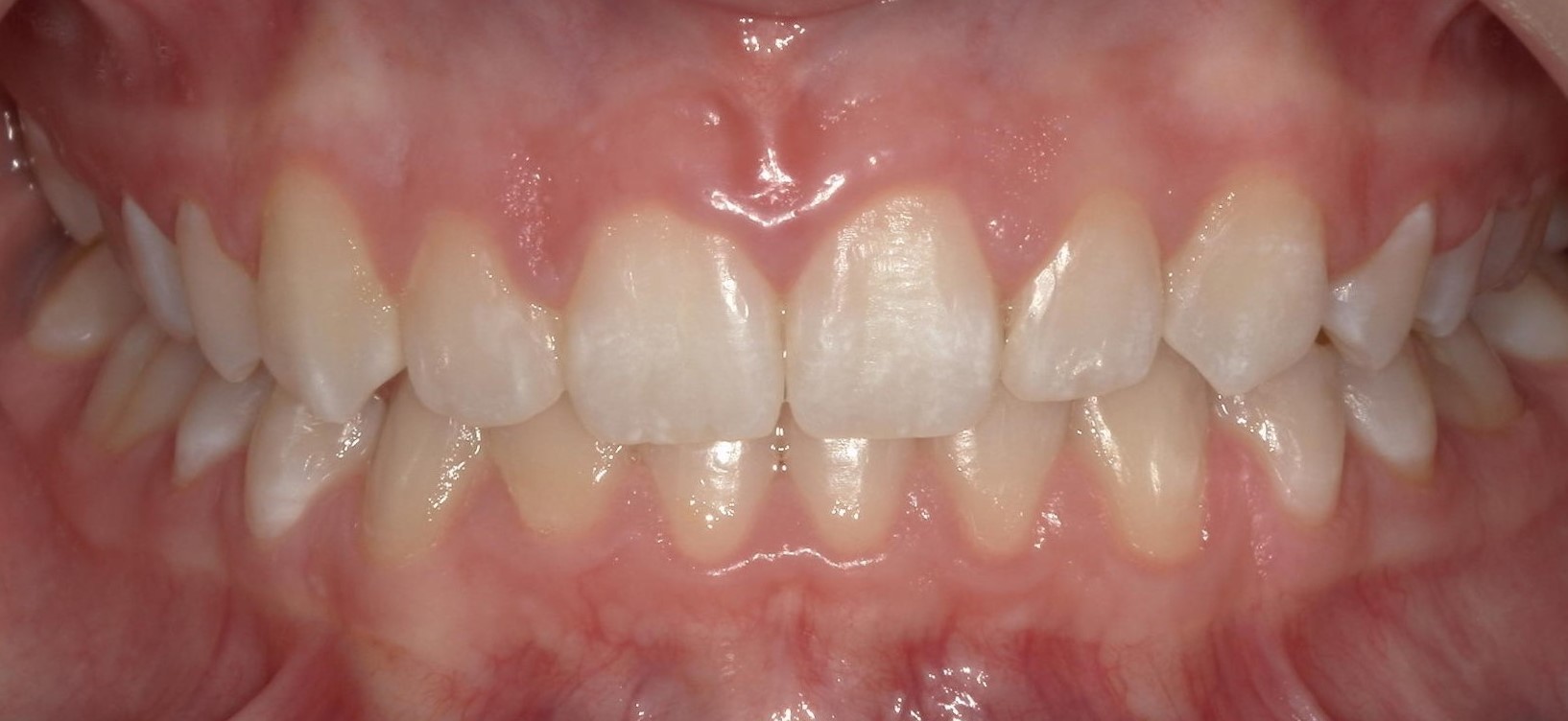 Orthodontics patient after treatment