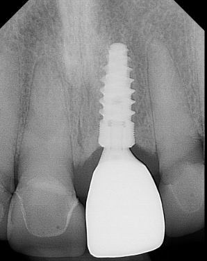 Dental implant patient after treatment