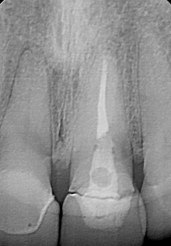 Dental implant patient before treatment