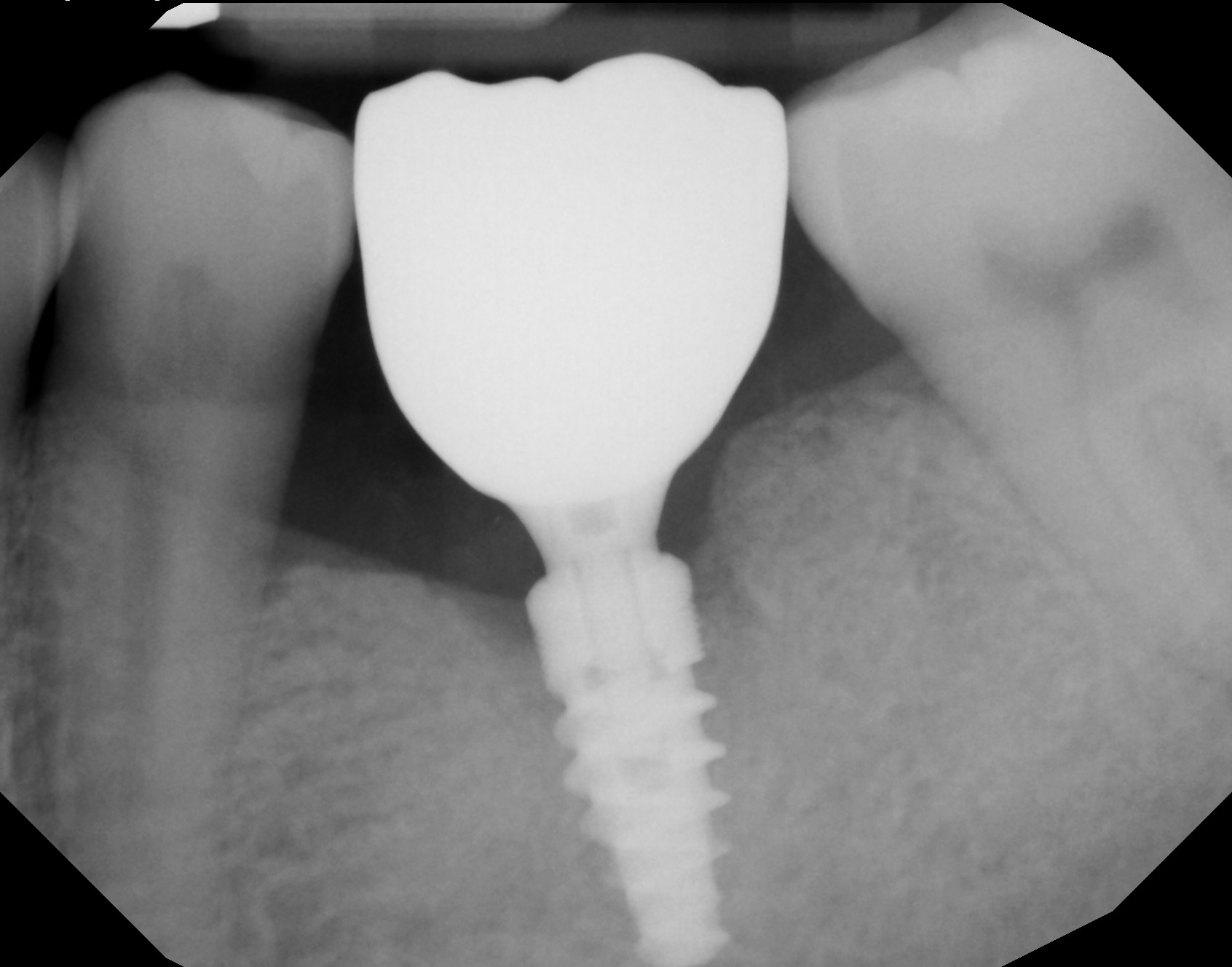 Dental implant patient after treatment