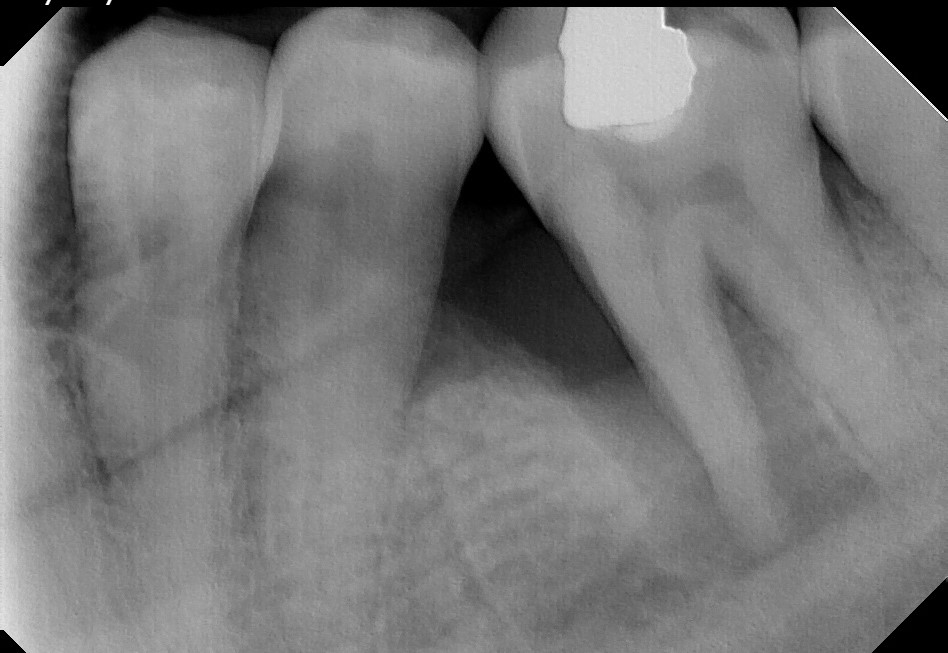 Dental implant patient before treatment