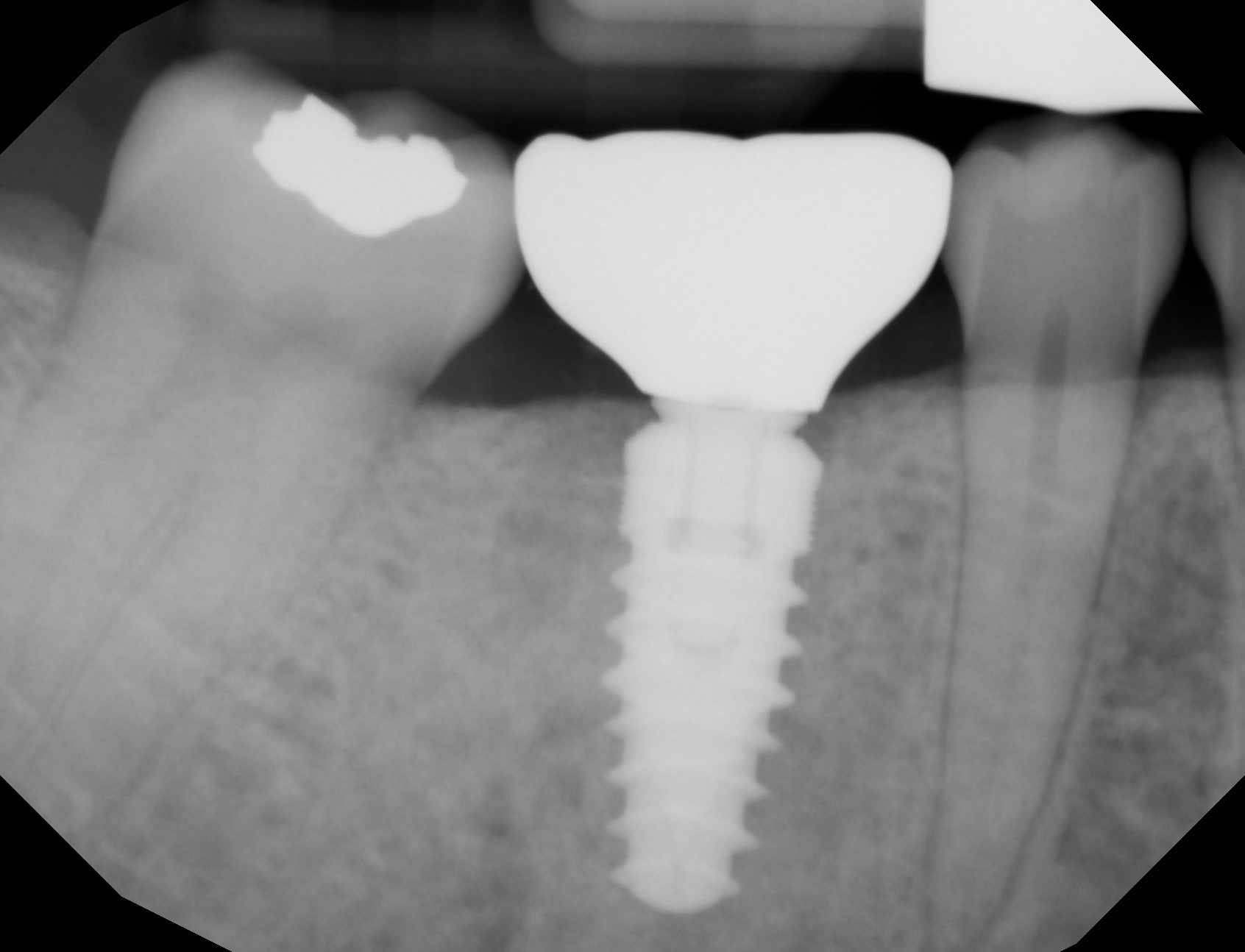 Dental implant patient after treatment
