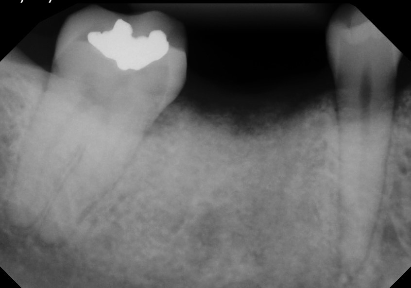 Dental implant patient before treatment