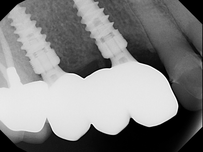 Dental implant patient after treatment