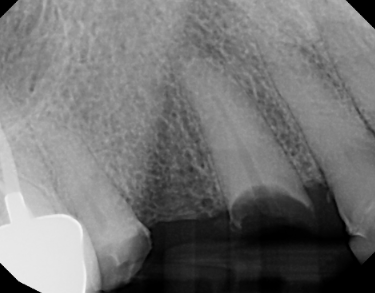 Dental implant patient before treatment
