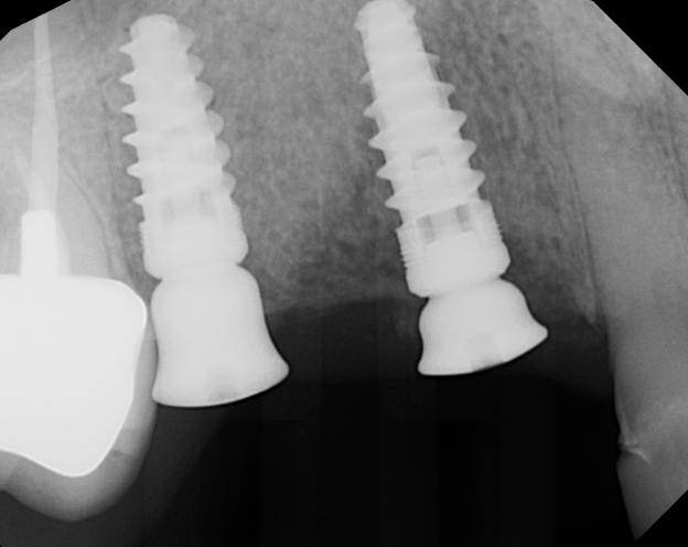 Dental implant patient during treatment