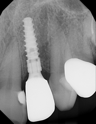 Dental implant patient after treatment