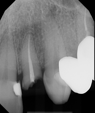 Dental implant patient before treatment