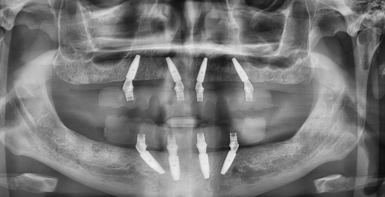 Panoramic x-ray after dental implant treatment