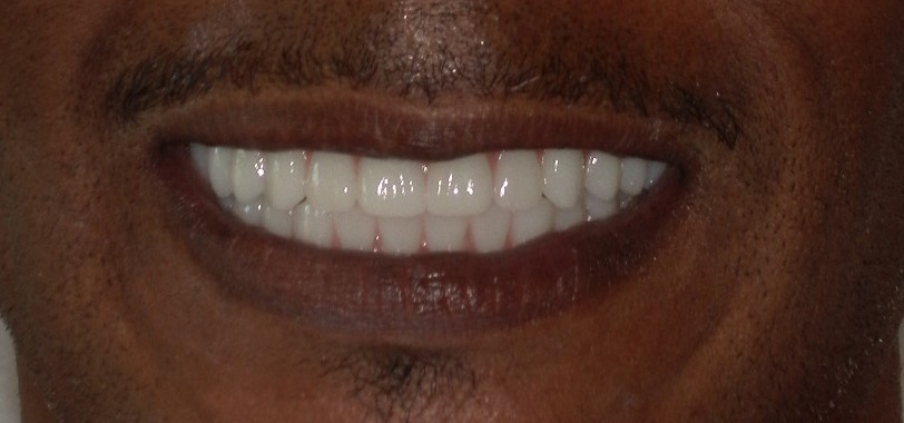 Full-mouth dental implant patient after treatment